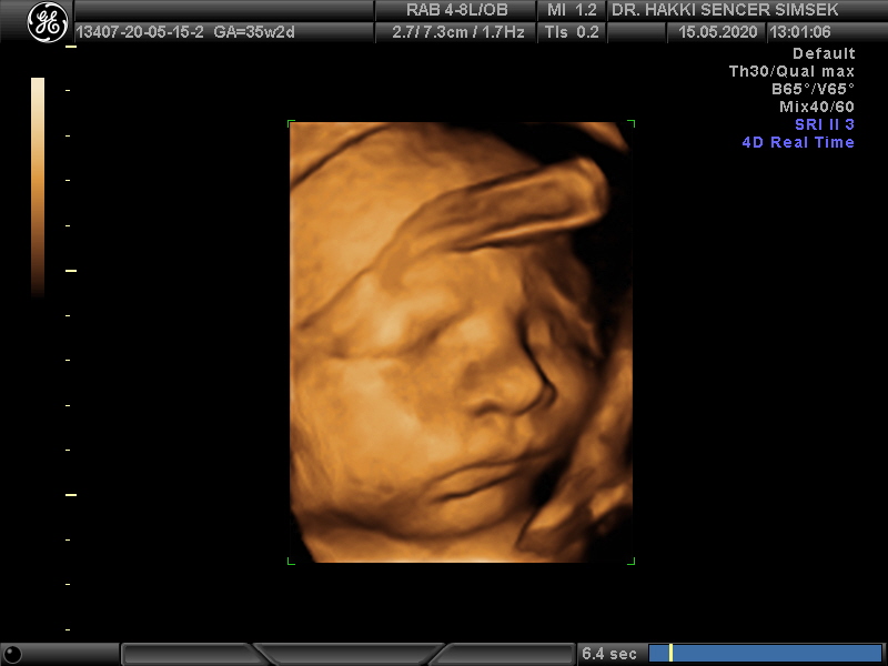 Gebelik Takibi ve Ultrasonun Önemi