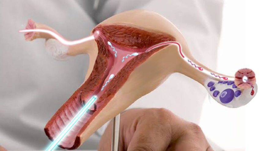 Aşılama İle Gebelik (IUI)